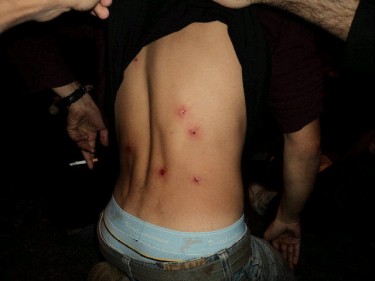 Un egipcio muestra heridas de bala en la espalda. Foto de Gigi Ibrahim.