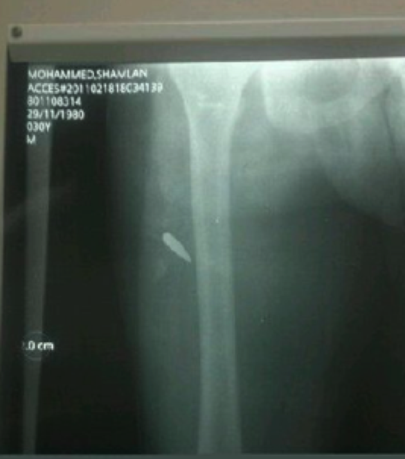@ba7rainiDXB Mohamed Alshamlan shot in the leg with live ammunition by the Khalifi Army, X-ray picture #Bahrain #Feb14