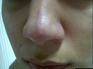 Bruised nose of a student at Al-Ahd Al-Zaher Secondary Girls School fighting with the school's nurse who was protesting inside the school