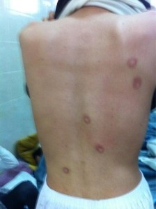 Marks of rubber bullets on the back of a stateless protester, who was earlier arrested. Photo shared by @m_f7 on mobypicture.