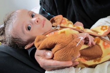 Ernstig ondervoed Jemenitisch kind, Sanaa, Jemen, april 2012. Foto van Al Jazeera (CC BY-NC-ND 3.0).