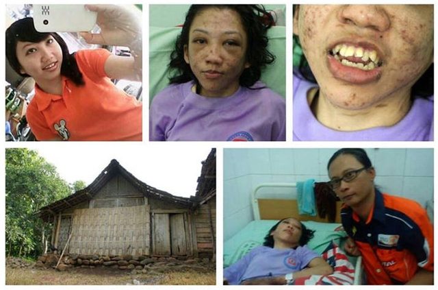 Erwiana Sulistayaniangsih, a foreign domestic helper from Indonesia, was found severely injured in the Hong Kong airport when she returned home last week on January 10. She told her fellow maid on flight that she was beaten and tortured for months but too scared to report the case to the police. She was hospitalized soon after she arrived and the case was exposed. More from Hong Wrong.