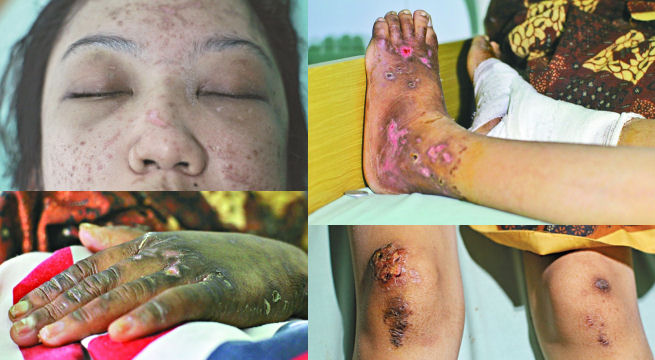 Il giorno 10 gennaio 2014, all’aeroporto di Hong Kong, sono stati riscontrate evidenti ferite fisiche sul corpo di Erwiana Sulistyaningsih. Immagini tratte dal Apple Daily News, vietata ogni riproduzione a scopo commerciale.